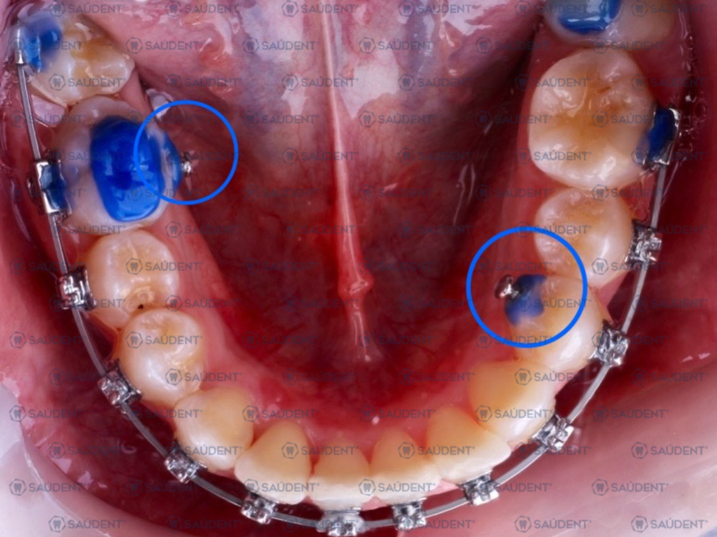 BOTÓN LINGUAL BASE REDONDA METAL 10PZ/PACK