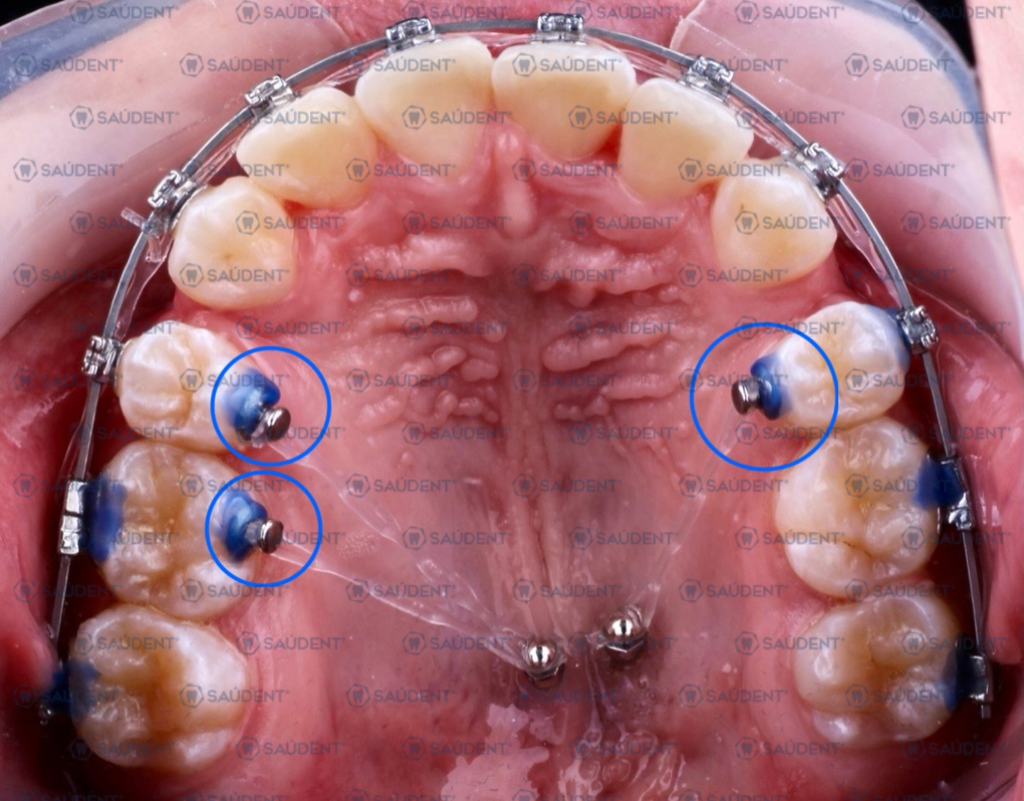 BOTÓN LINGUAL BASE REDONDA METAL 10PZ/PACK