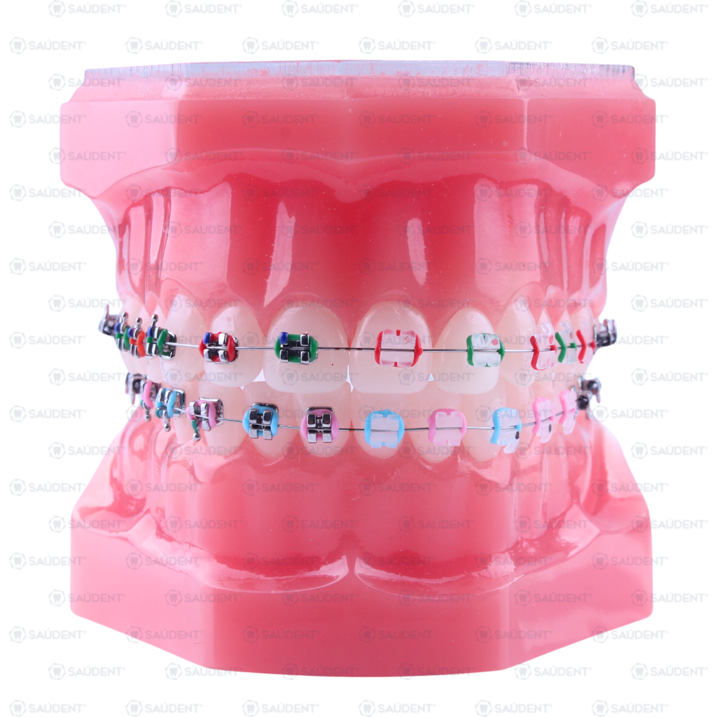 TIPODONTO KLASIKO CERAMICO + KLASIKO METALICO